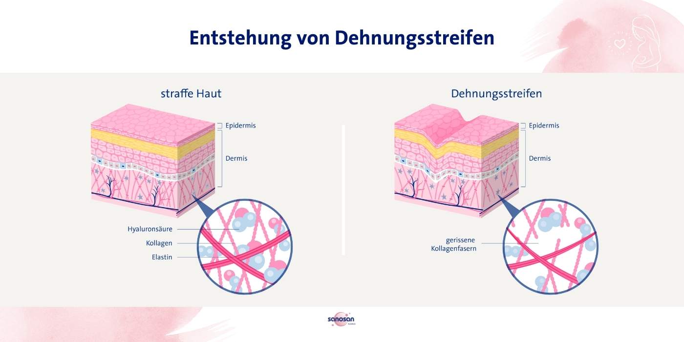 Wie entstehen Schwangerschaftsstreifen?