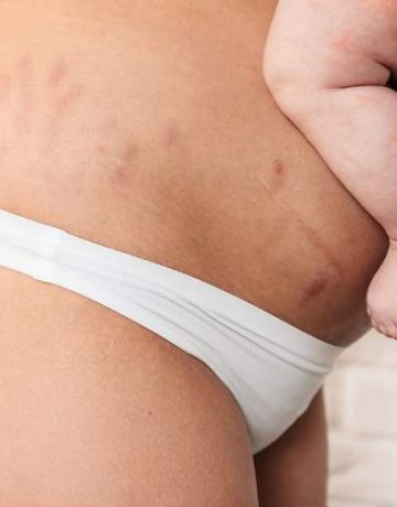 Frau mit Dehnungsstreifen am Bauch und Baby auf dem Arm