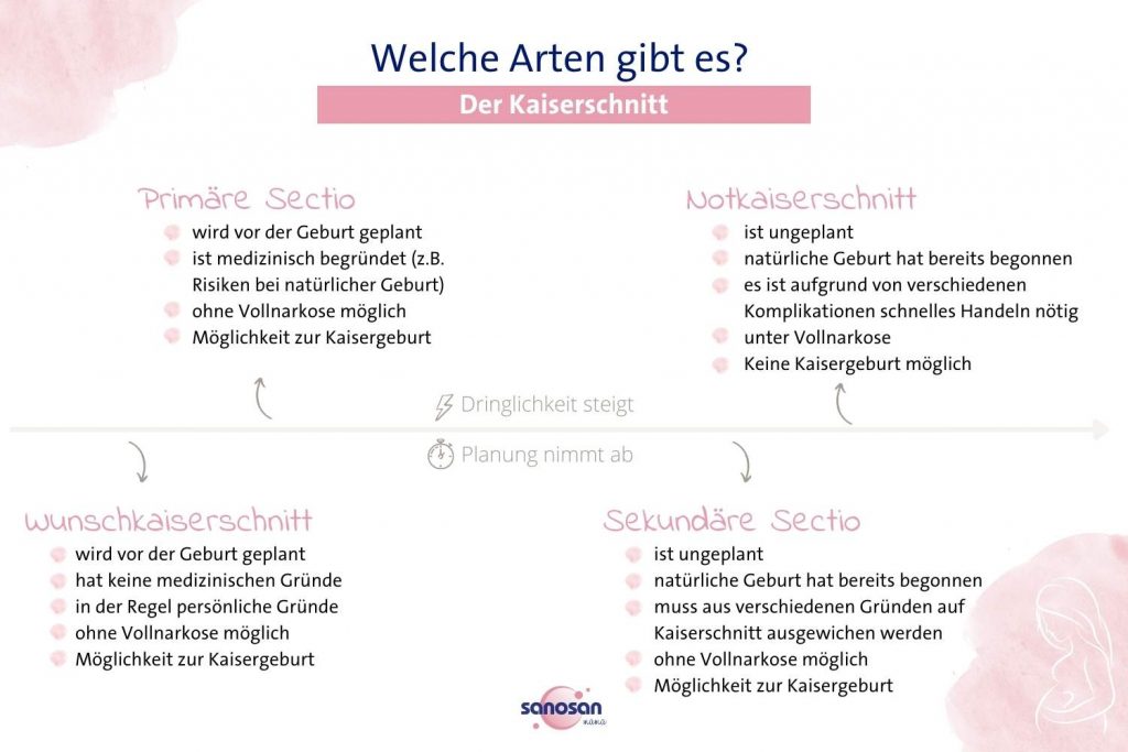 Infografik zu verschiedenen Arten des Kaiserschnitts