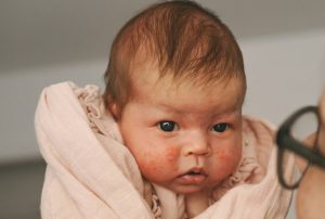 baby-mit-babyakne