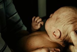 baby-mit-gelbsucht