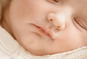 baby mit-vergroesserten-talgdruesen